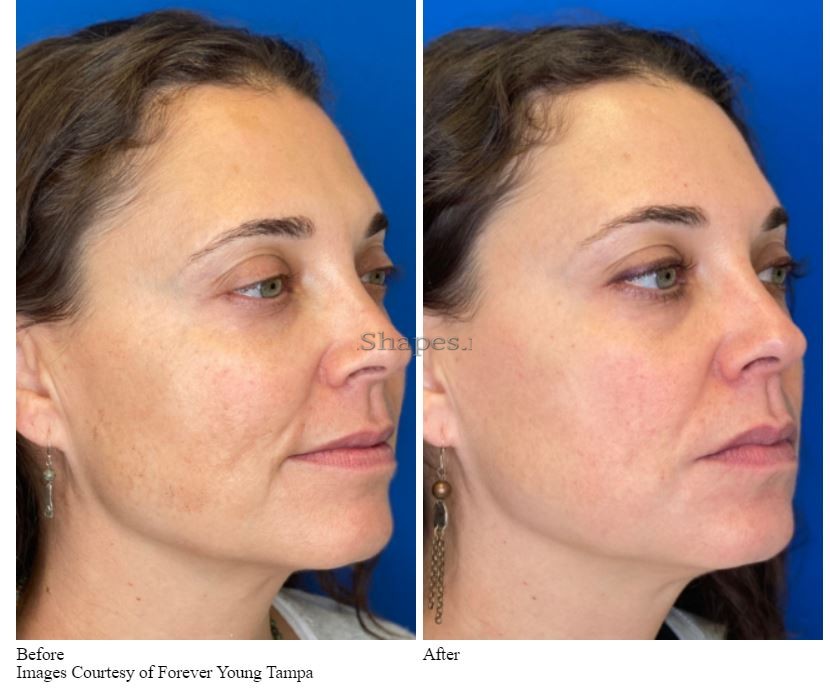Virtue RF Microneedling before after
