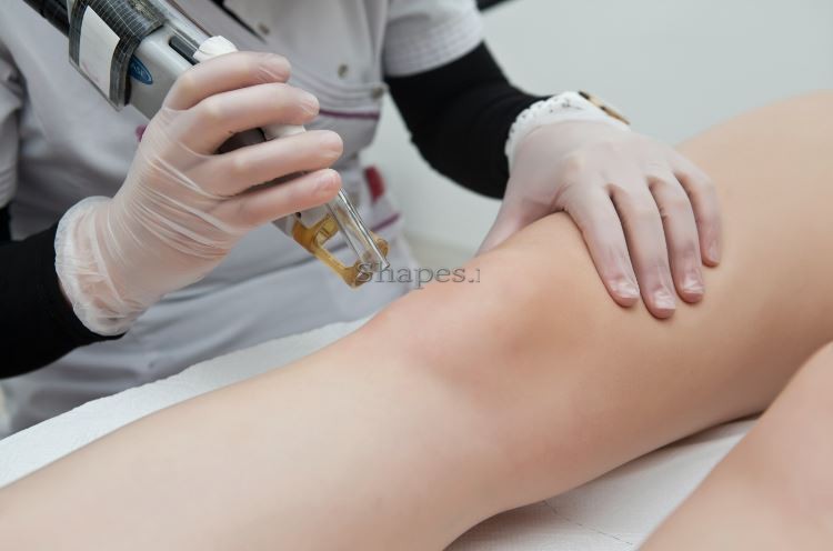 laser hair removal annapolis