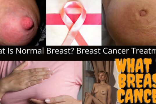 what is Breast cancer